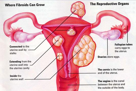 Nzingha lecture 36. Fibroids, What Sisters need to know | Blacknet UK